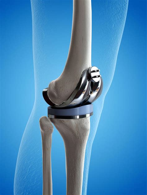 Knee replacement surgery in Greenwich .